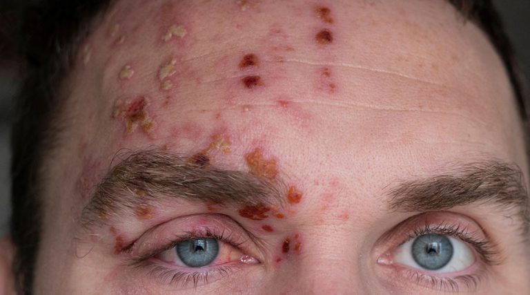 Hives On The Forehead Everything You Need To Know