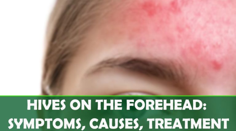Hives on the forehead: symptoms, causes, treatment