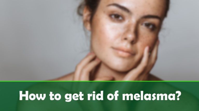 How to get rid of melasma?