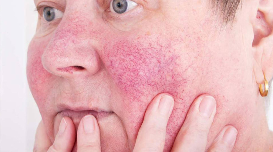 Rosacea