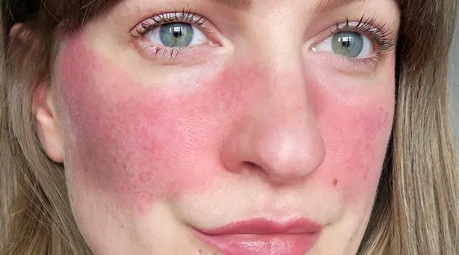 cheek redness